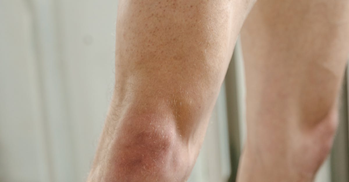 The Importance of Nutritional Support during Knee Rehabilitation
